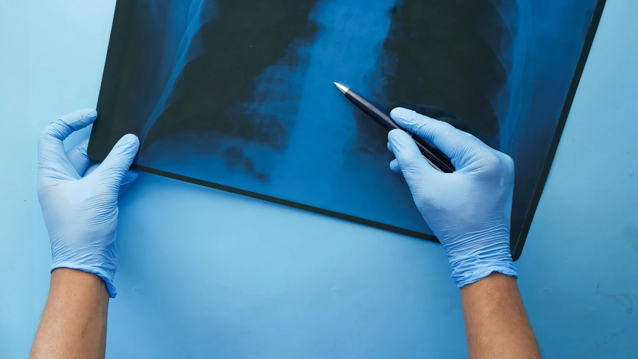 KRAS G13X Mutations Identify a Distinct Lung Cancer Subgroup - MDNewsline